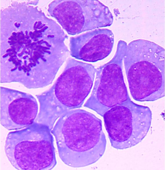 myeloma cell